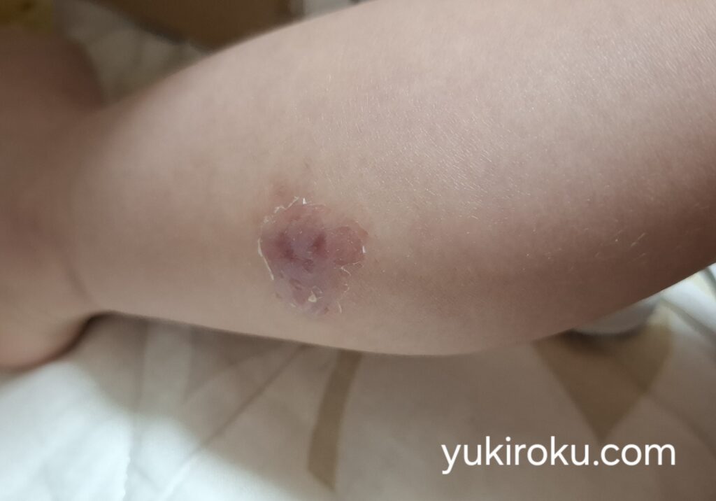 とびひ一歩手前だった傷跡